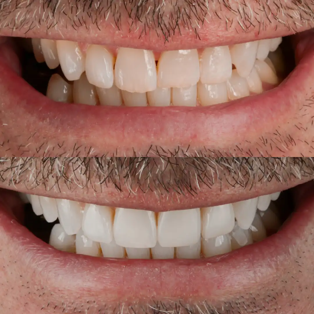 Gap closure and refined smile line after whitening, composite edge bonding and one veneer at The Dental Barns near Lichfield and Sutton Coldfield.