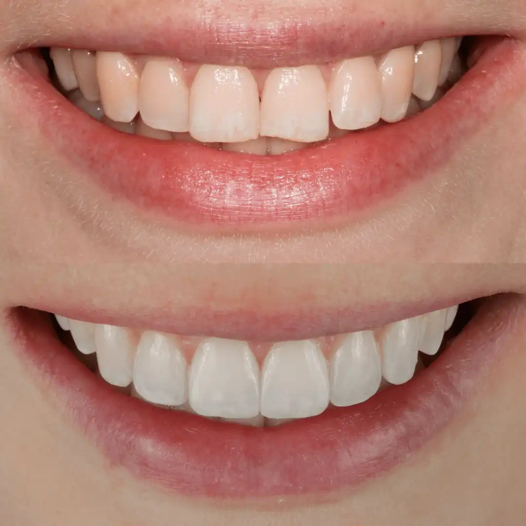 Aligned and brightened smile with Invisalign, whitening and natural composite edge bonding at The Dental Barns near Lichfield and Sutton Coldfield.