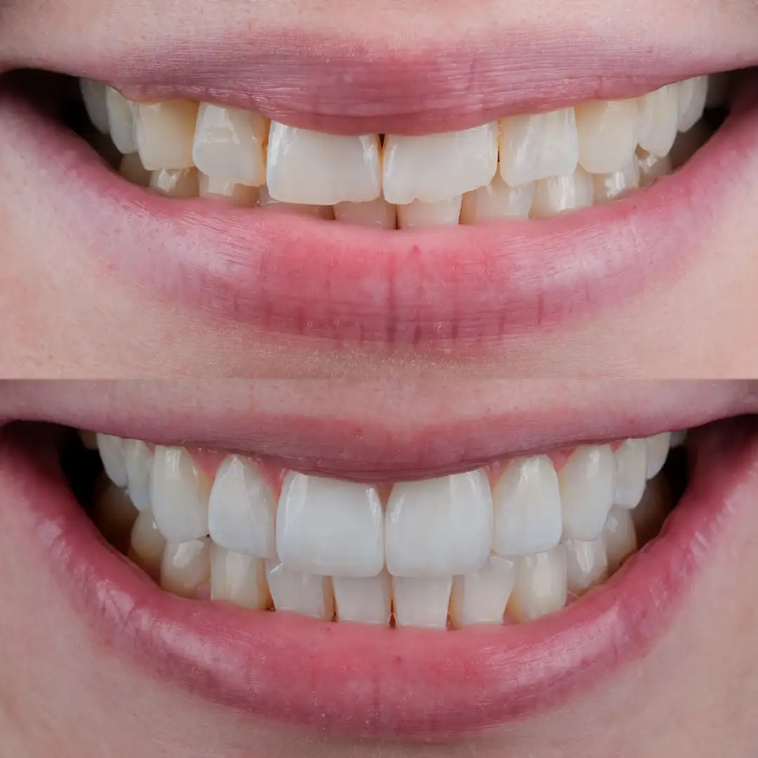 Brighter, balanced smile after composite edge bonding and handcrafted composite veneers at The Dental Barns near Lichfield and Sutton Coldfield.