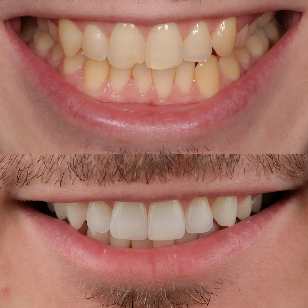 Edge wear improved with Invisalign, whitening, composite edge bonding and one veneer at The Dental Barns near Lichfield and Sutton Coldfield.