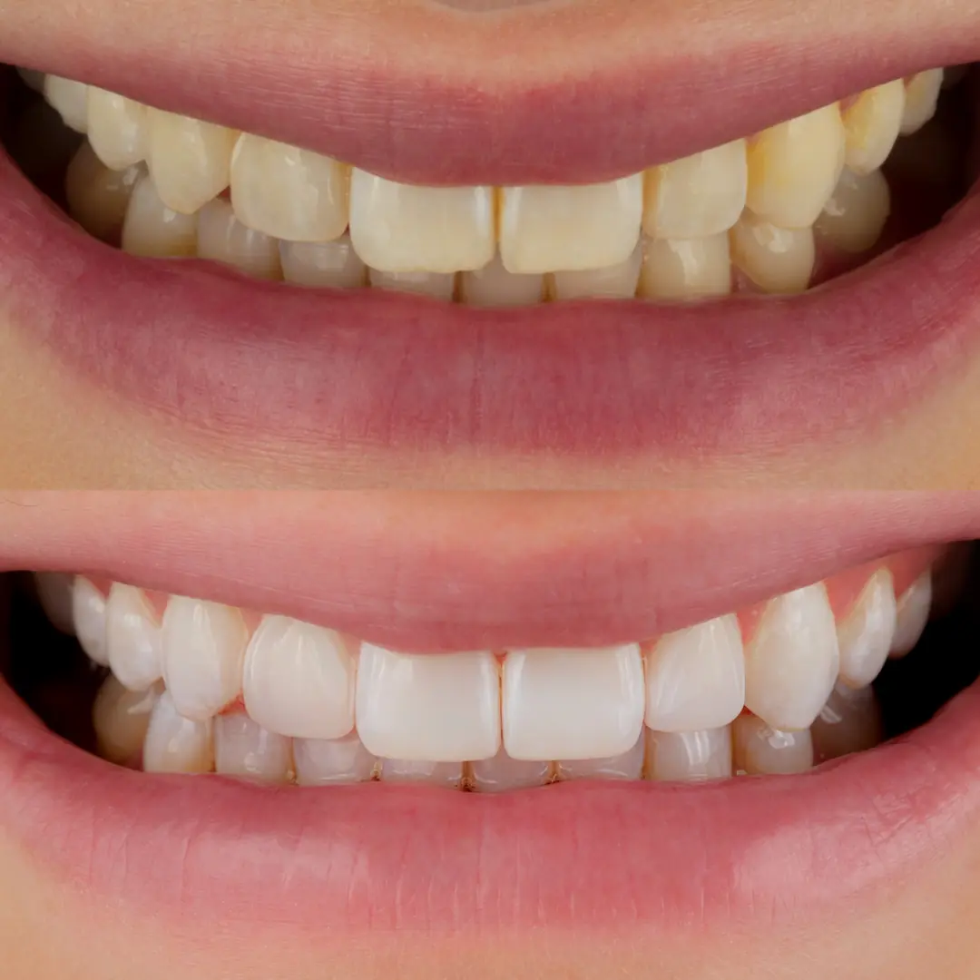 Teeth whitening and composite edge bonding on four front teeth at The Dental Barns, serving patients near Lichfield and Sutton Coldfield.