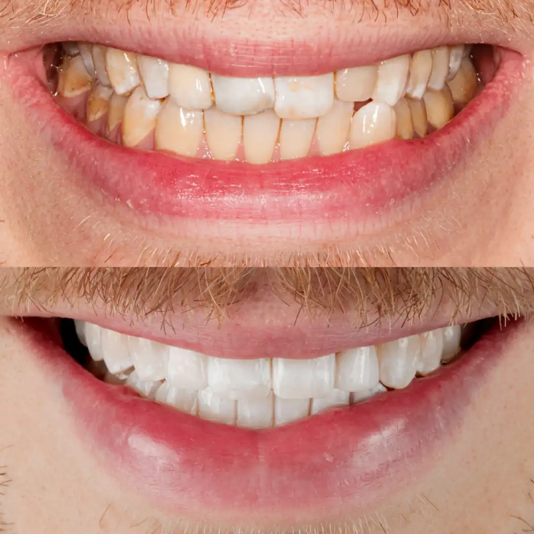 Invisalign and a single composite veneer creating a brighter, balanced smile at The Dental Barns near Lichfield and Sutton Coldfield.