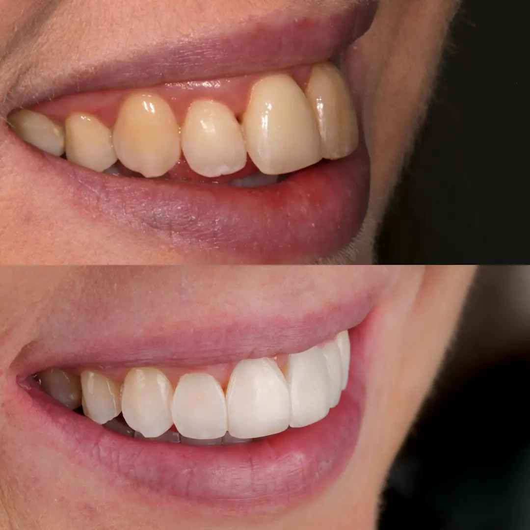 Wedding smile makeover with Invisalign, whitening and composite veneers by The Dental Barns, serving Lichfield and Sutton Coldfield.