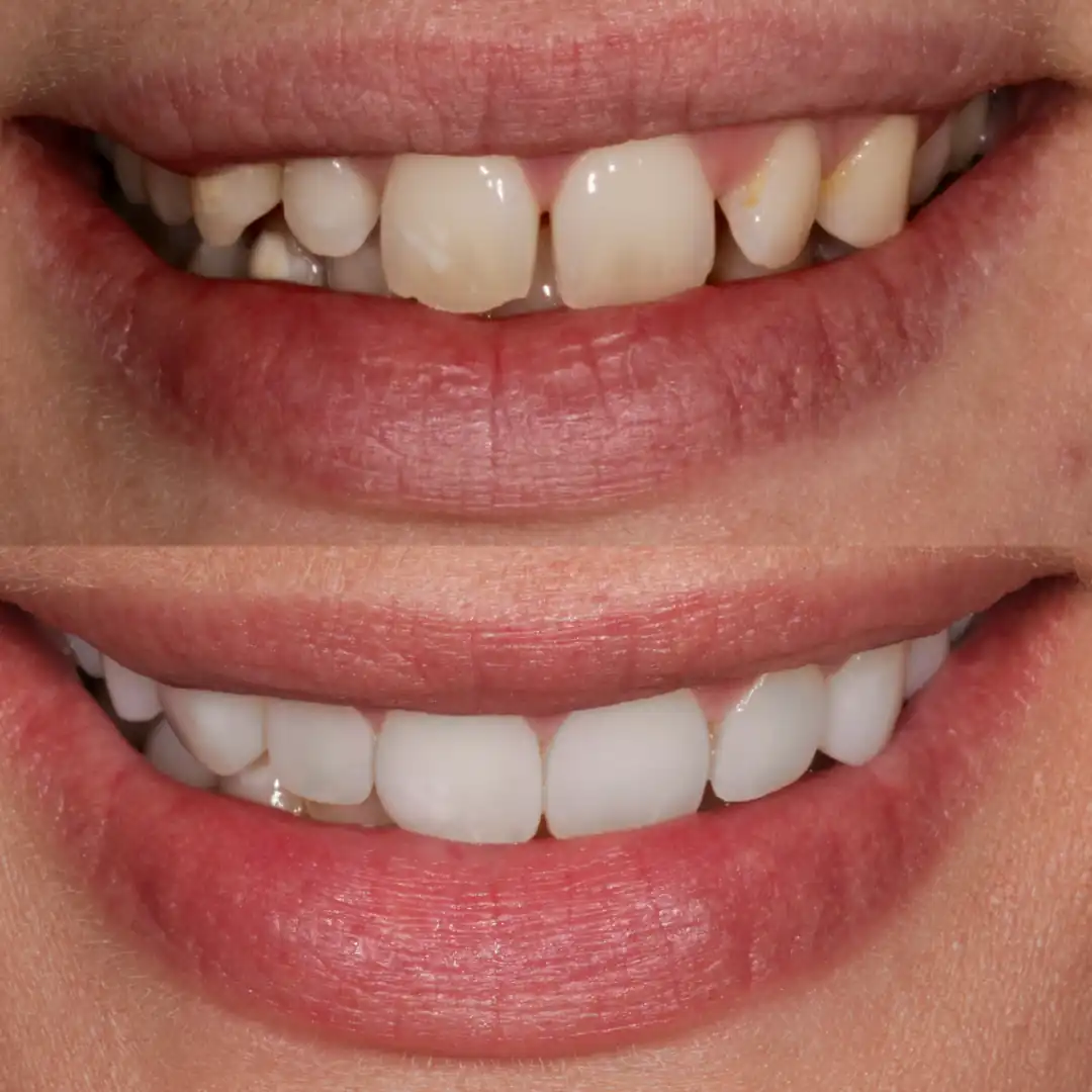 Before-and-after gap closure with clear aligners, whitening and freehand composite veneers at The Dental Barns near Lichfield and Sutton Coldfield.