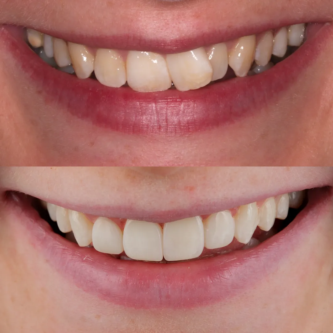 Invisalign, Enlighten whitening and four composite veneers creating a harmonious smile at The Dental Barns near Lichfield and Sutton Coldfield.