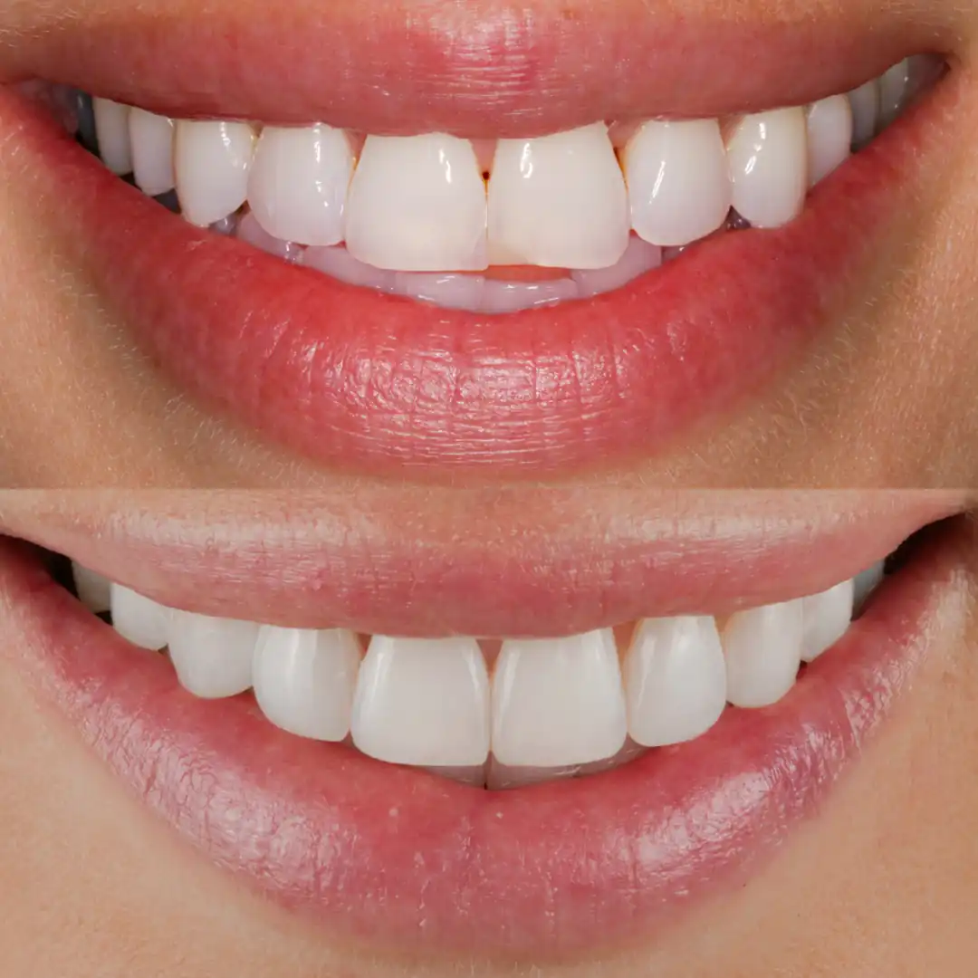 Brighter, straighter smile finished with composite edge bonding to the front teeth at The Dental Barns, near Lichfield and Sutton Coldfield.