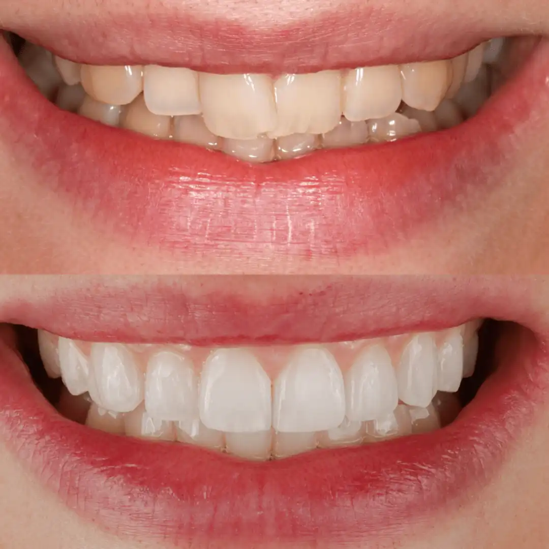 Invisalign, whitening and subtle composite edge bonding before-and-after smile at The Dental Barns near Lichfield and Sutton Coldfield.