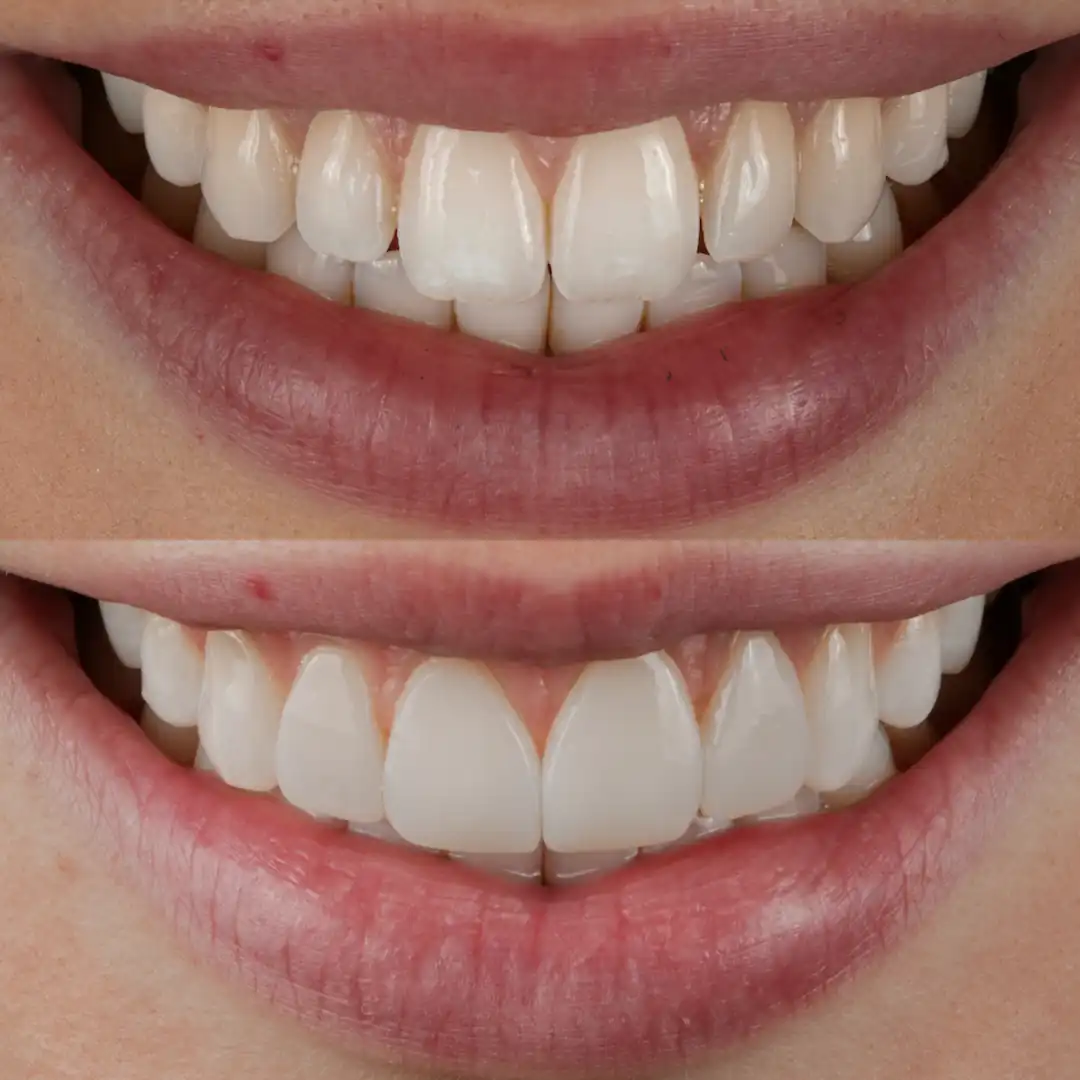 Softer, more balanced front teeth after composite bonding at The Dental Barns, a cosmetic dental practice near Lichfield and Sutton Coldfield.