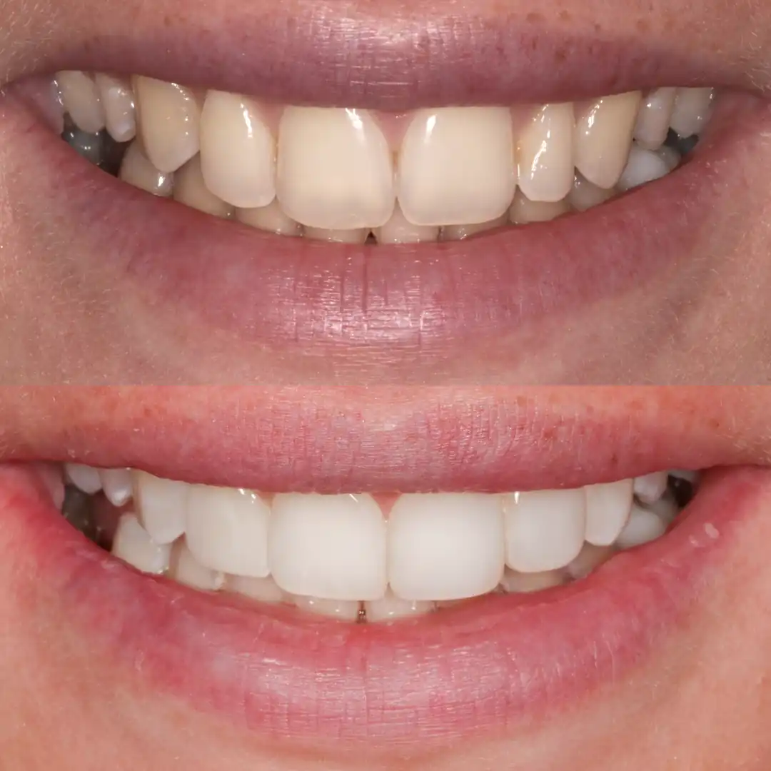 Natural smile makeover with teeth whitening and four composite veneers at The Dental Barns, serving patients near Lichfield and Sutton Coldfield.