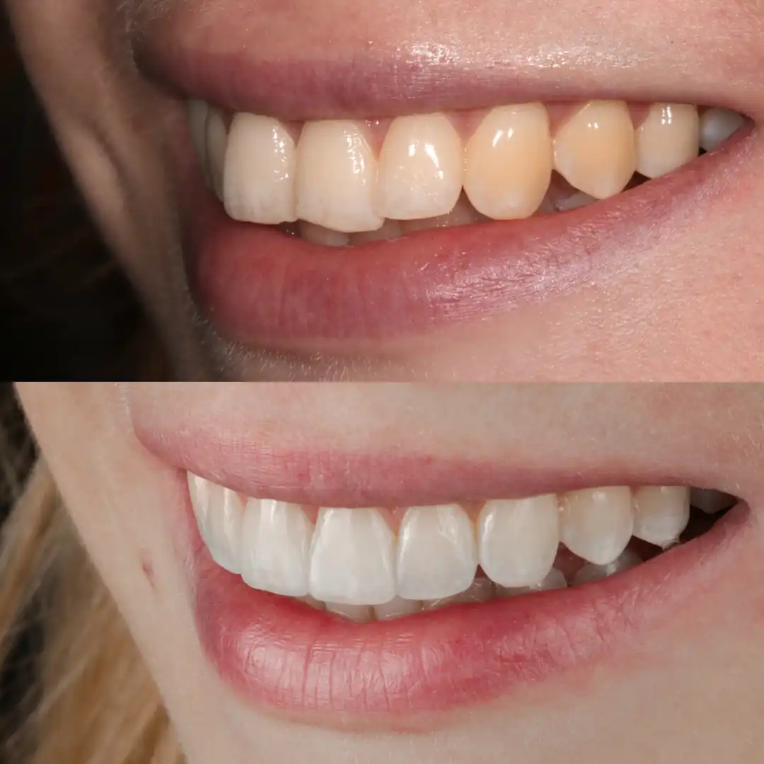 Before-and-after natural smile refinement using Invisalign, whitening and composite edge bonding at The Dental Barns near Lichfield and Sutton Coldfield.