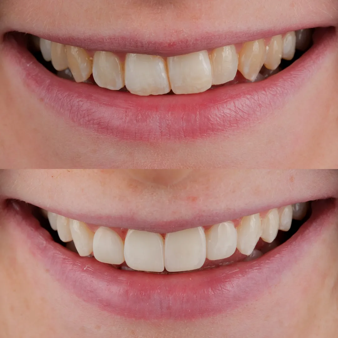 Brighter, balanced smile after Enlighten whitening and four layered composite veneers at The Dental Barns near Lichfield and Sutton Coldfield.