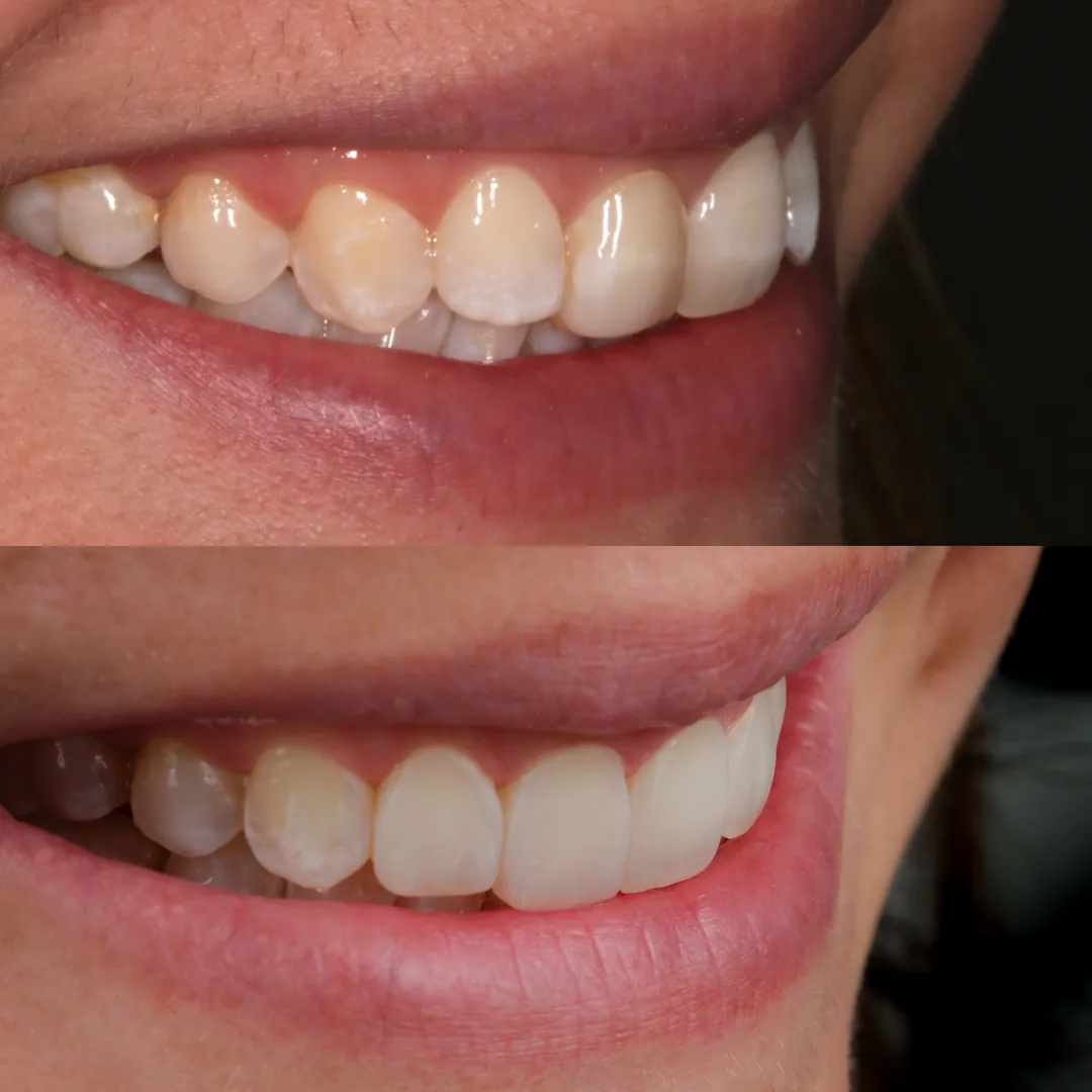 Before-and-after smile brightening with Enlighten whitening and four composite veneers at The Dental Barns near Lichfield and Sutton Coldfield.