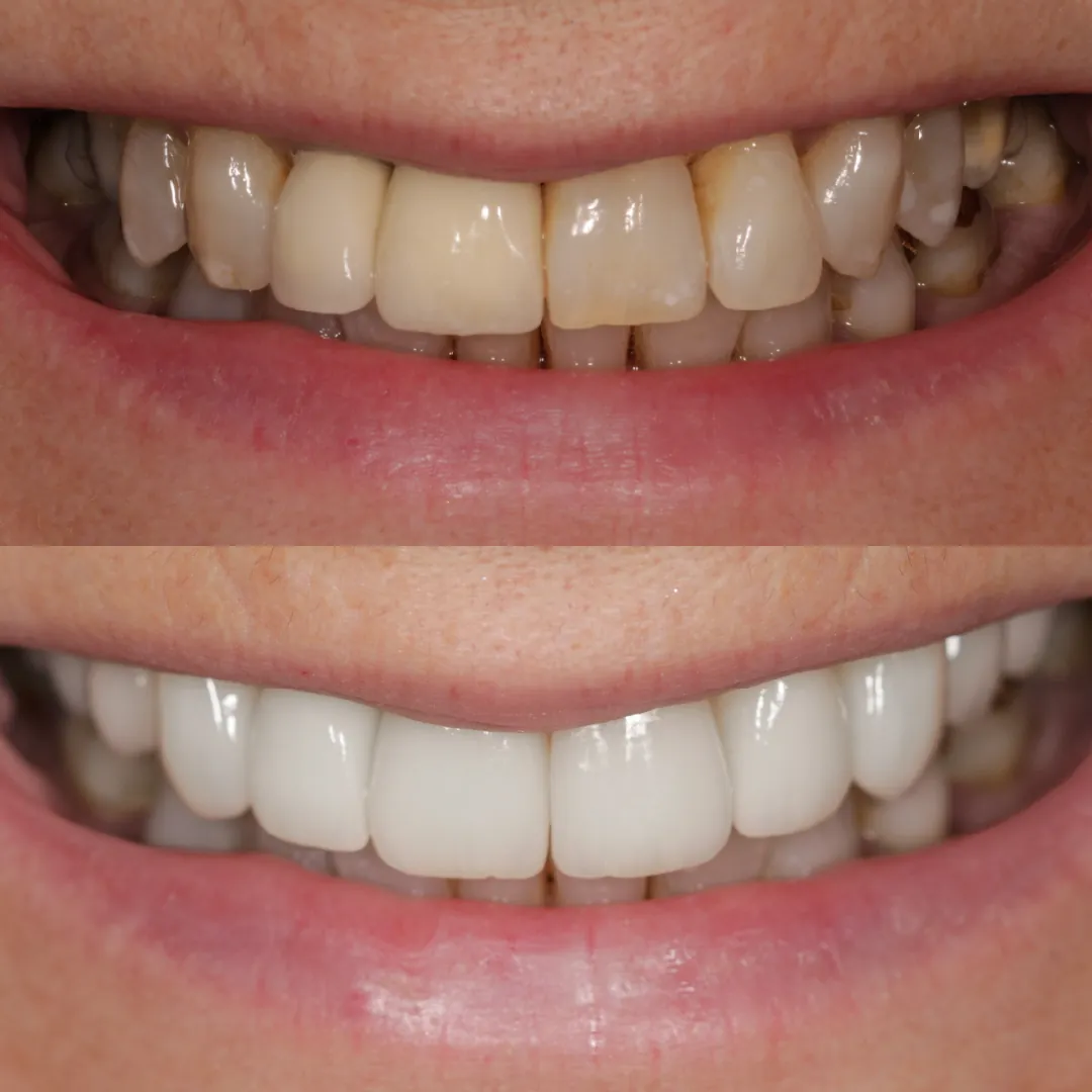 Existing veneers replaced with six e.max porcelain veneers and four e.max crowns after whitening at The Dental Barns near Lichfield and Sutton Coldfield.