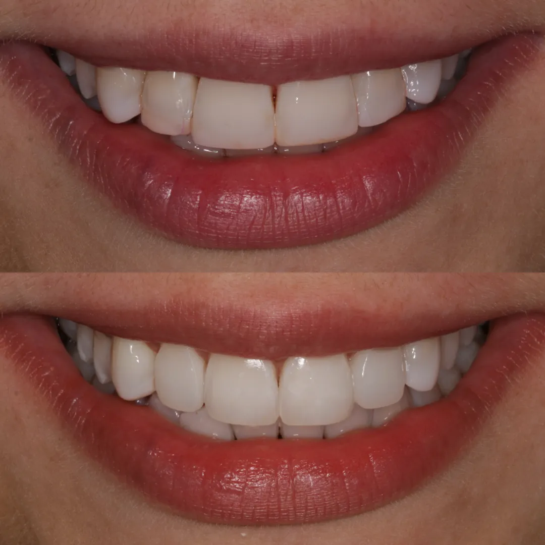 Before-and-after replacement of four composite veneers to restore natural tooth shape and smile balance at The Dental Barns near Lichfield and Sutton Coldfield.