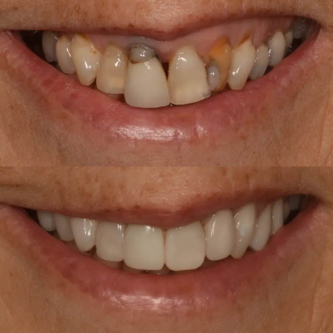Smile restored with six composite veneers and one e.max crown at The Dental Barns near Lichfield and Sutton Coldfield.