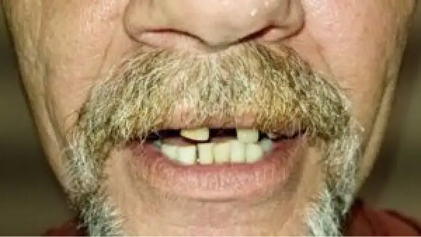A close up of a man with a mustache and missing teeth.