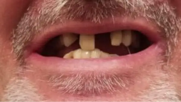 A close up of a man's mouth with teeth missing.