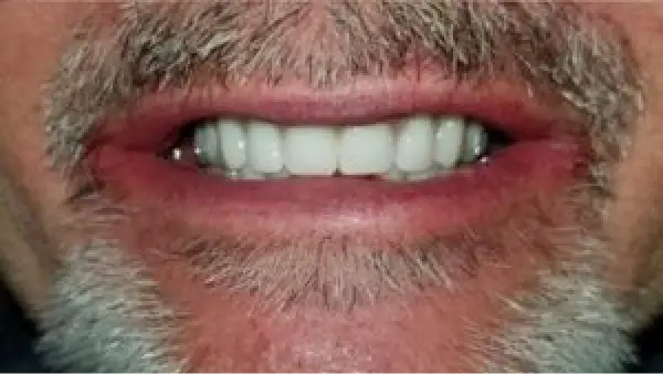 A close up of a man's teeth with white teeth.