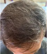Resultado do Rafael depois de 3 meses usando o Plano Completo com Finasterida e Minoxidil