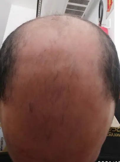 Foto do cabelo do Maureci antes de iniciar o tratamento