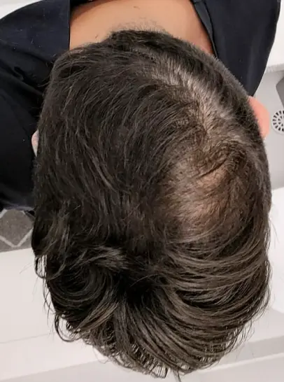 Resultado do Raul depois de 12 meses de tratamento