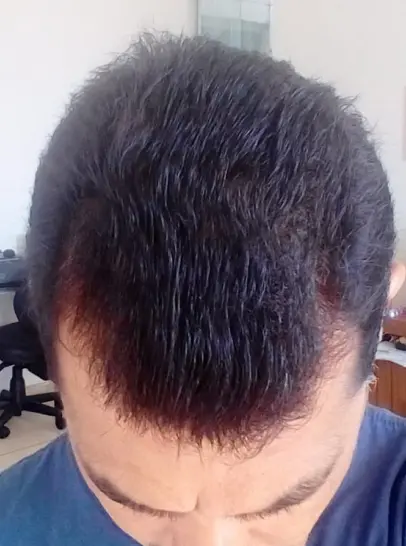 Resultado do Samuel depois de 4 meses de tratamento