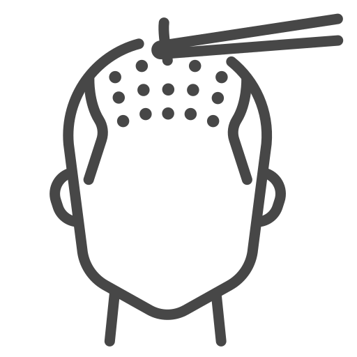 Hair Transplant Surgery in Istanbul, Turkey