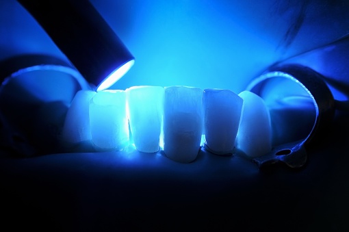 Composite Tooth Filling