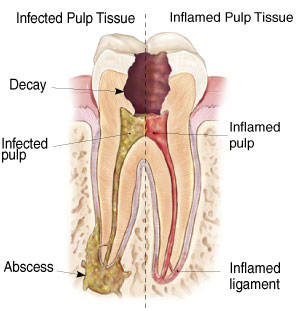 Root Canal Treatment