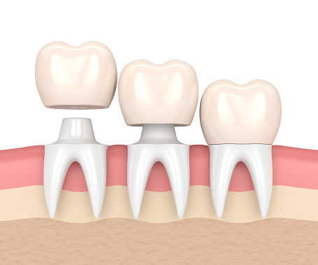 Image of dental crowns at Palo Alto Oral Health.
