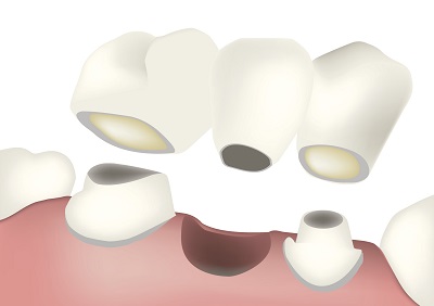 Dental Bridge