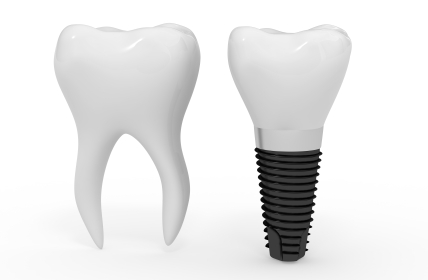 Mini Dental Implants