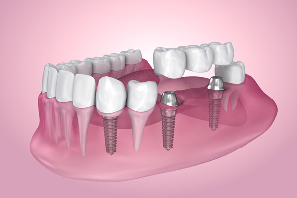 Multiple Tooth Dental Implants
