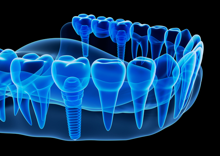 Dental Implants