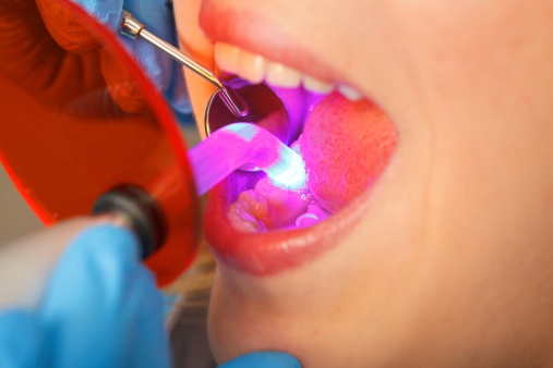 Modern Dental Bonding