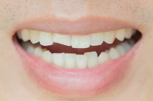 The Different Types of Tooth Cracks - What You Need to Know