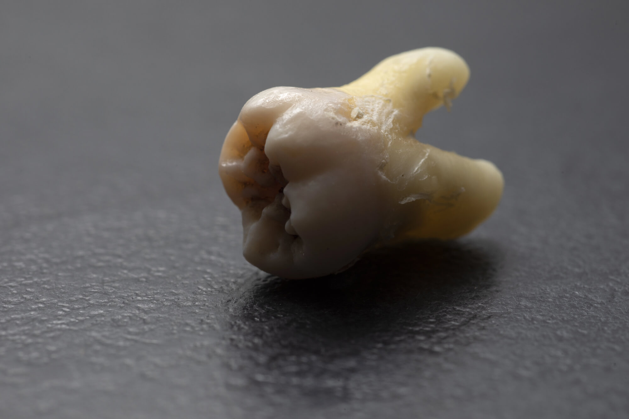 Emergency Dentist in Madison Explains How to Act if a Tooth Falls Out