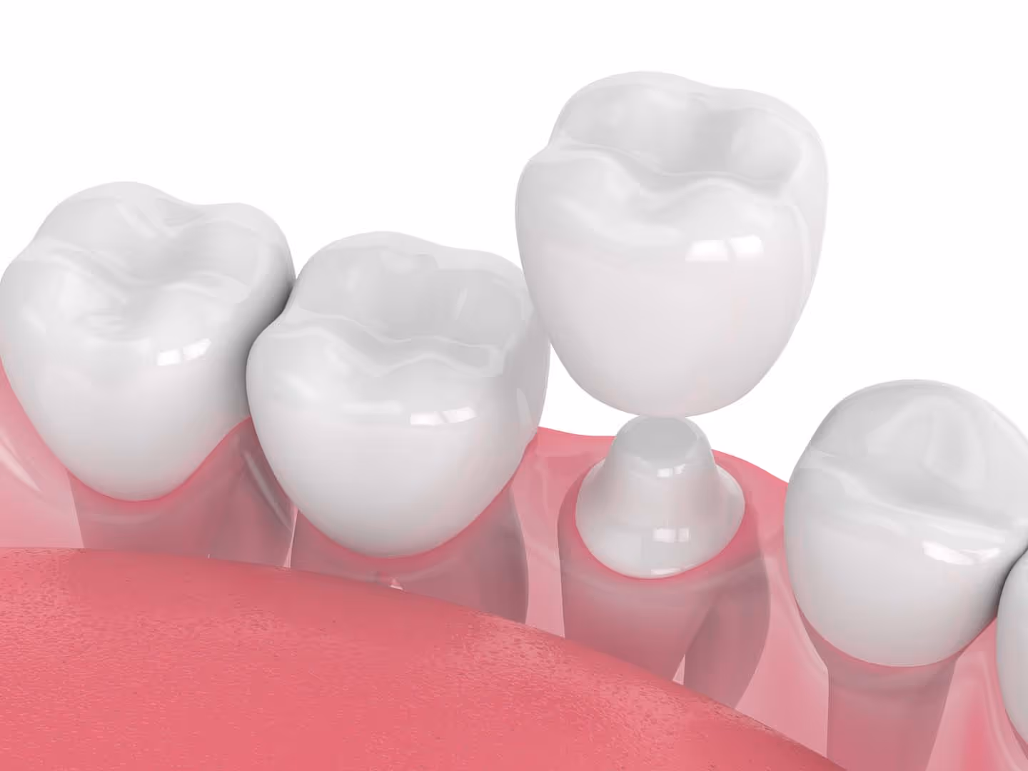 Dental Crowns in Orange Park, FL