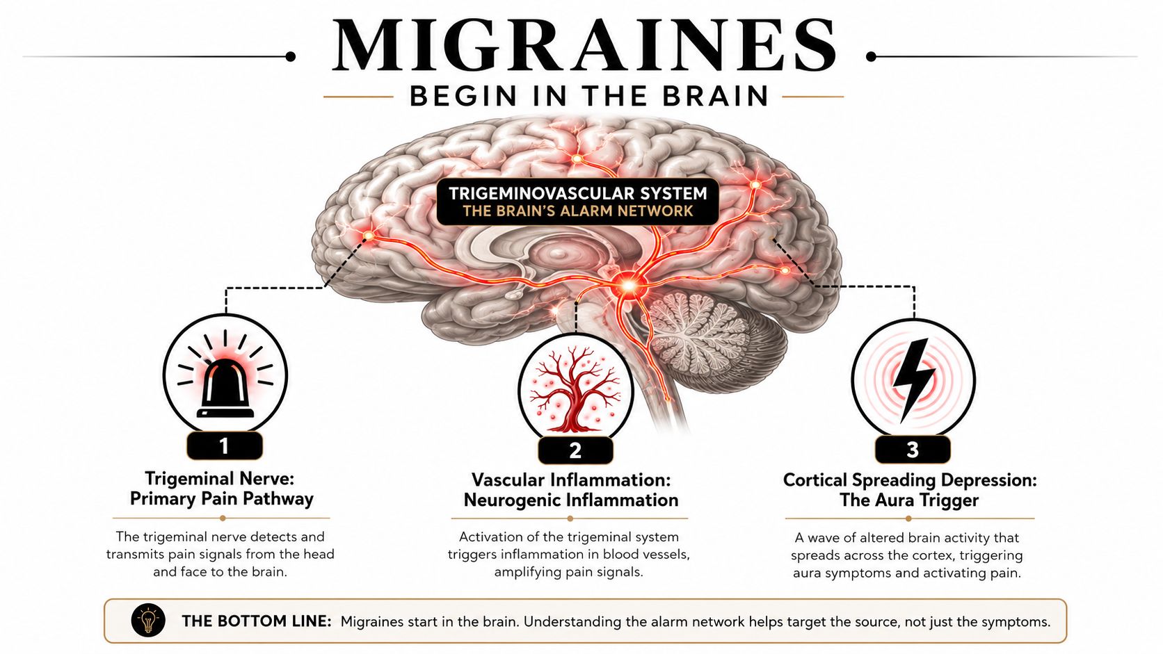A medical infographic showing the three main stages of the migraine process within the human brain.
