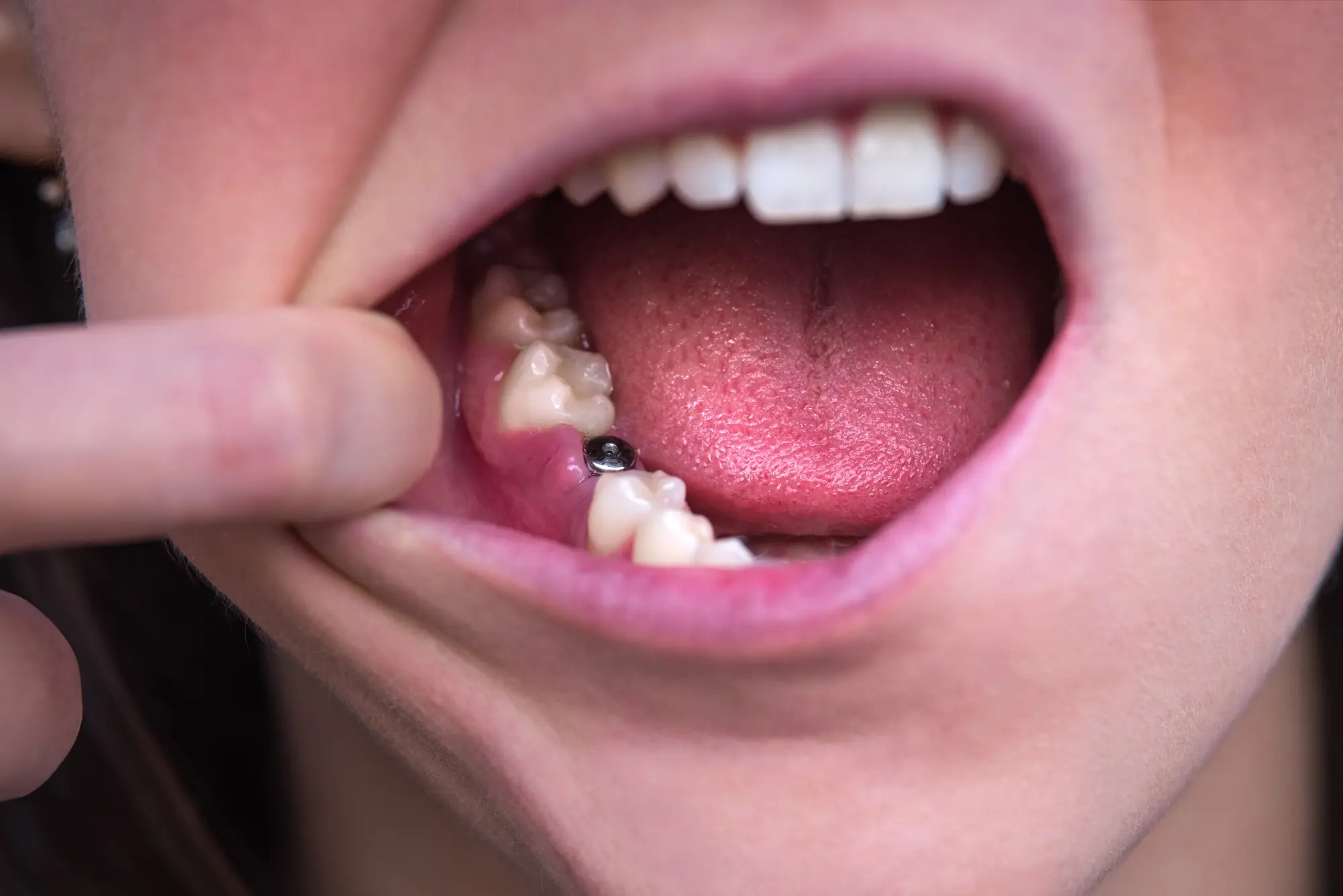 What is the Relationship Between Implant Pathway and New Horizon Dental Center?
