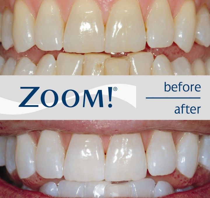 Is Teeth Whitening Right for You?
