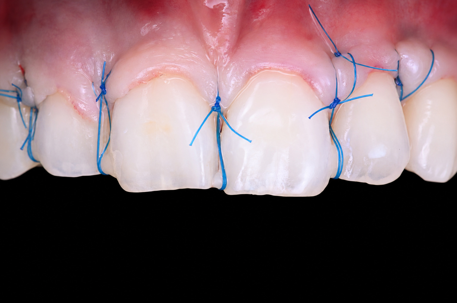 Chirurgie muco-gingivale