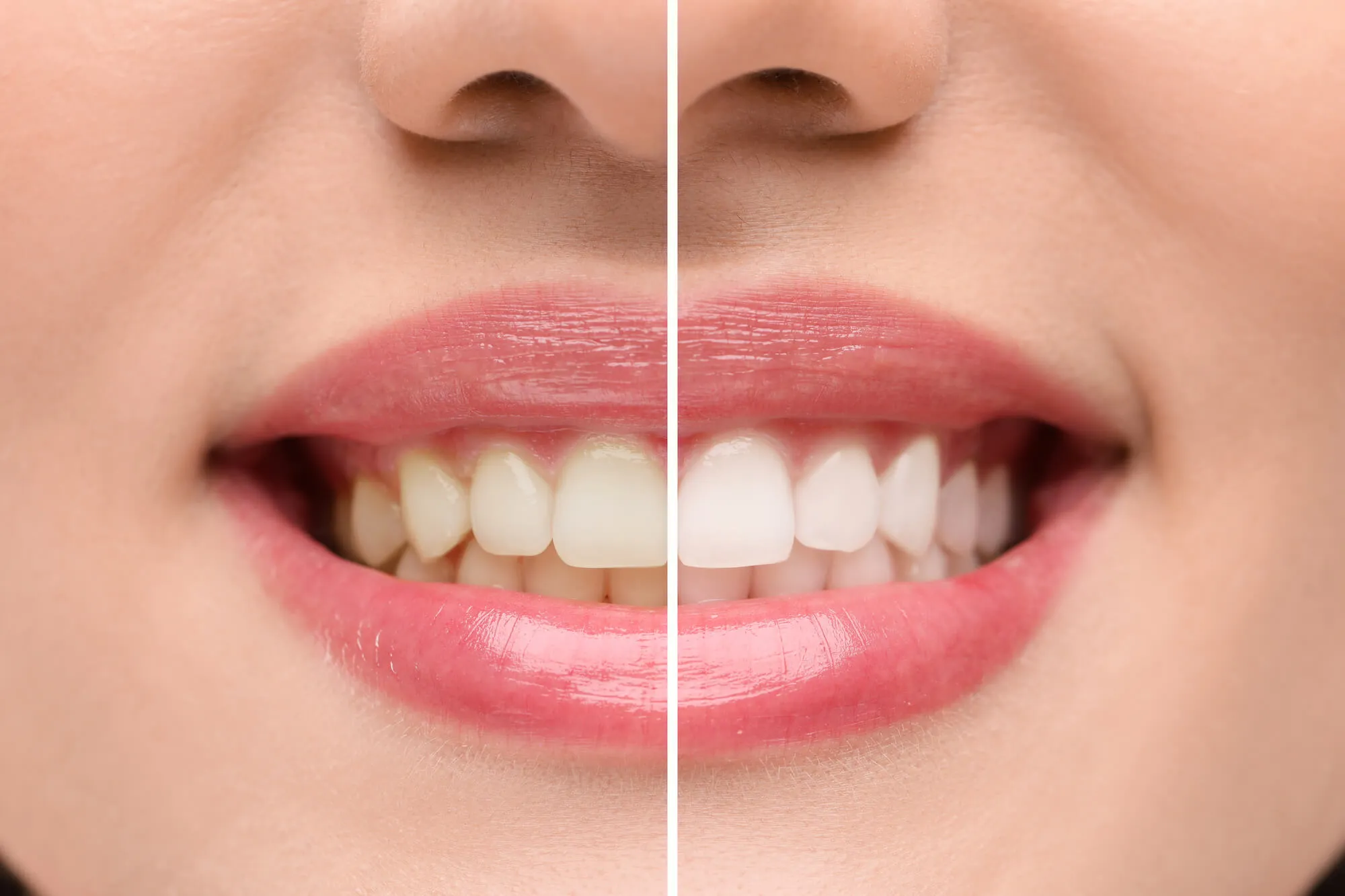 before and after professional teeth whitening