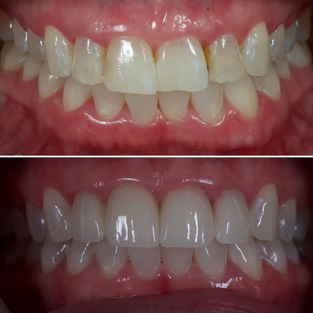 before and after cosmetic dental treatment