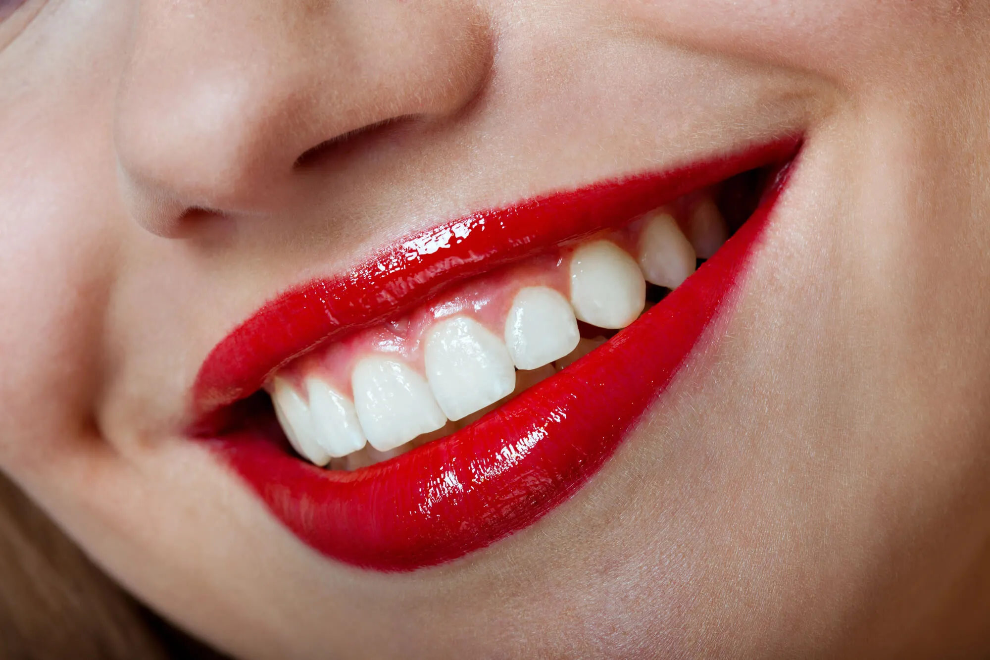 newly applied porcelain veneers clarksville tn