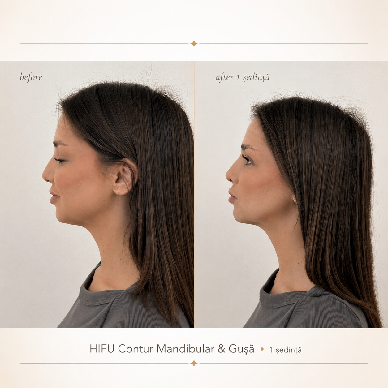 Înainte și după HIFU – contur mandibular și gușă, 1 ședință