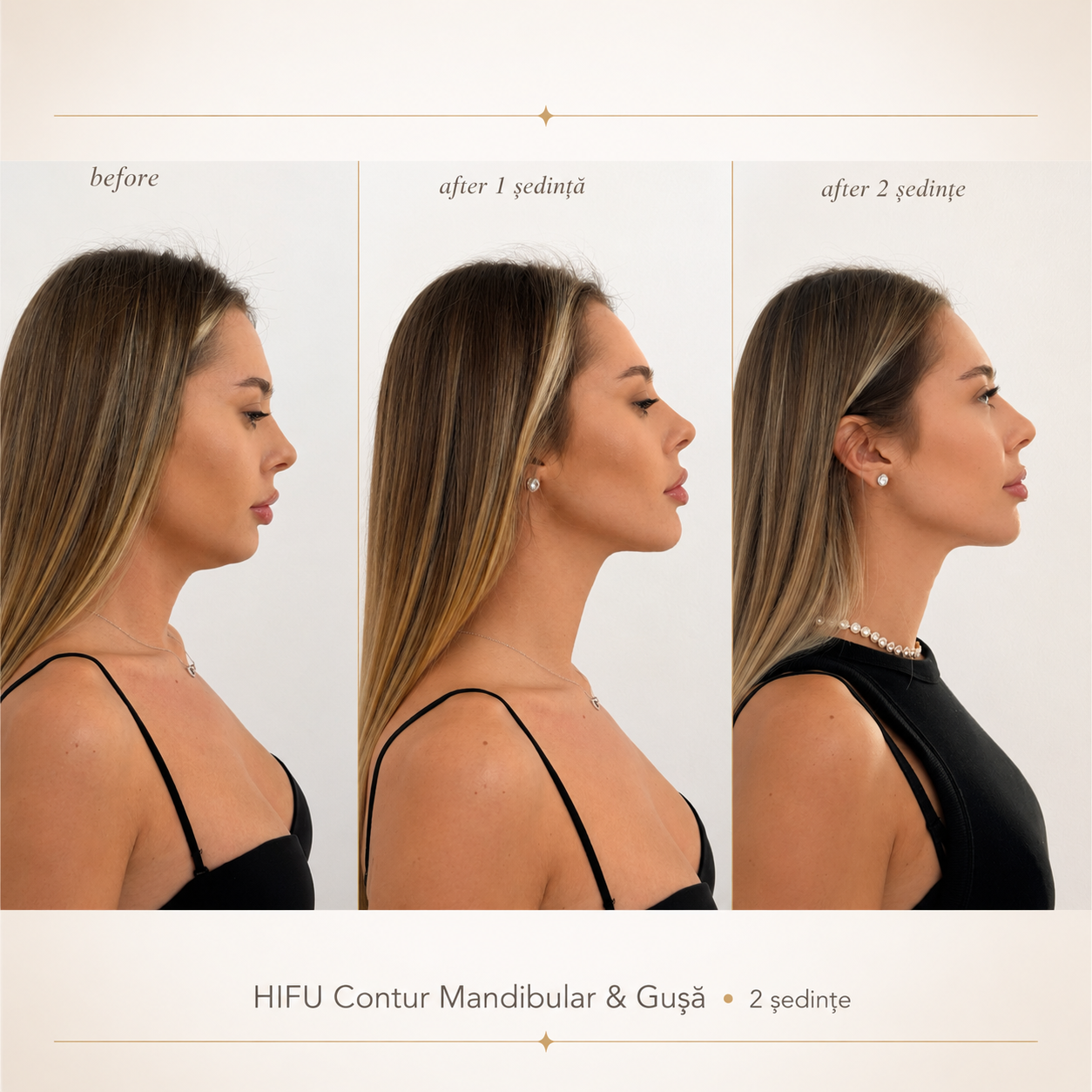 Înainte și după HIFU – contur mandibular și gușă, progres pe 2 ședințe