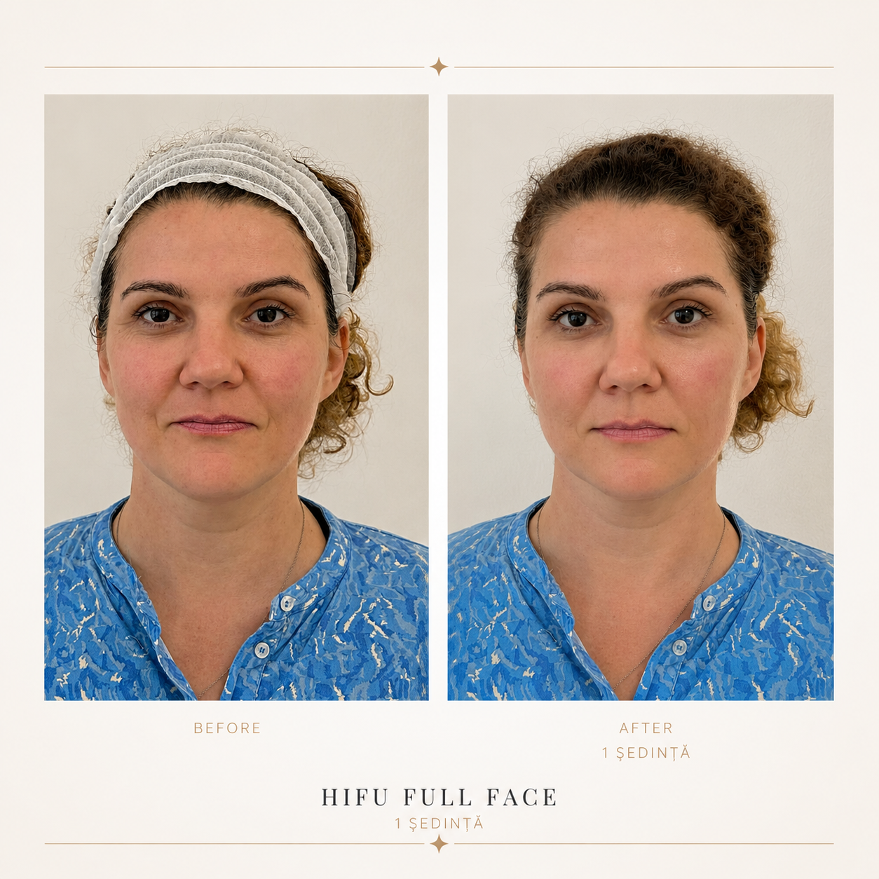 Înainte și după HIFU Full Face, 1 ședință