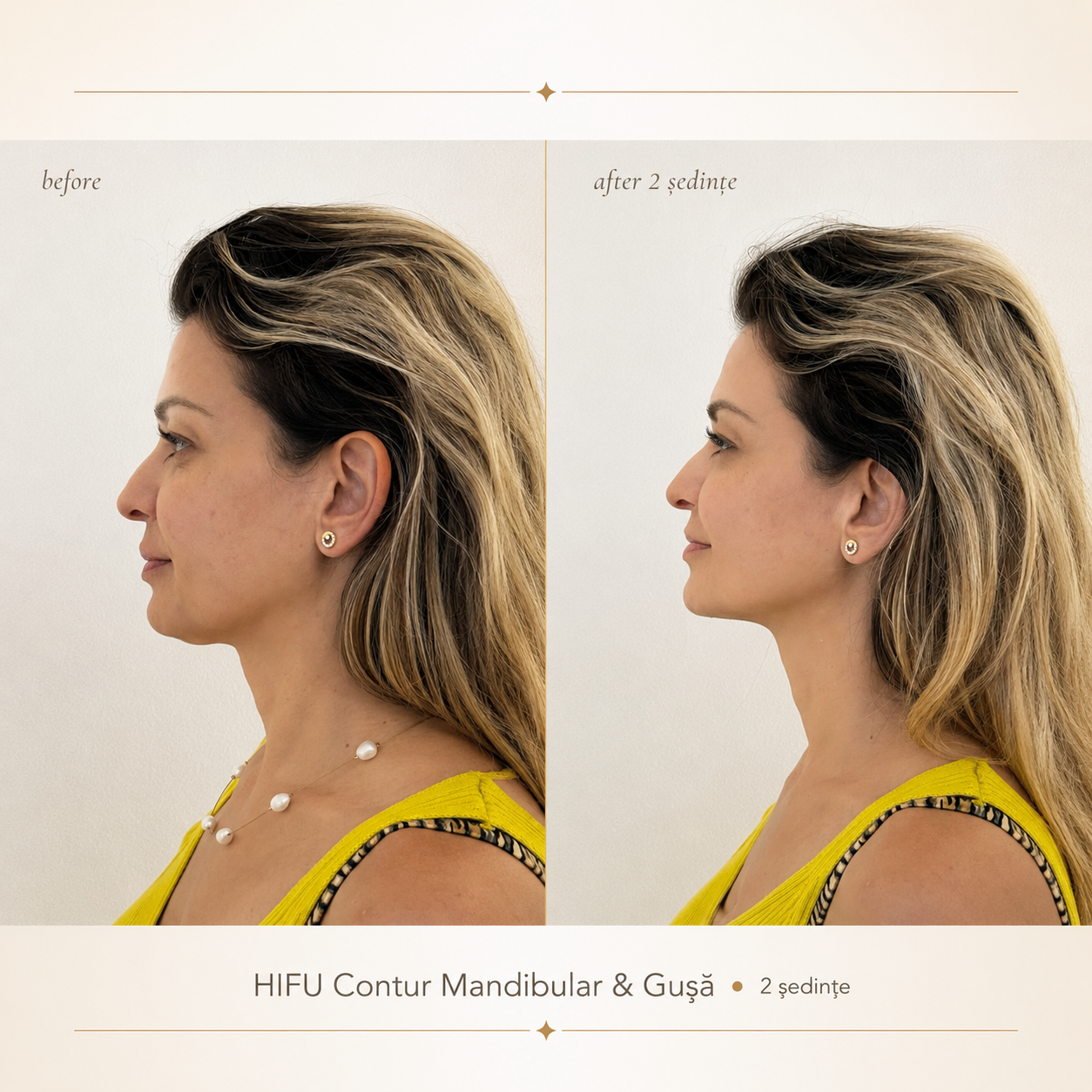 Înainte și după HIFU – contur mandibular și gușă, 2 ședințe