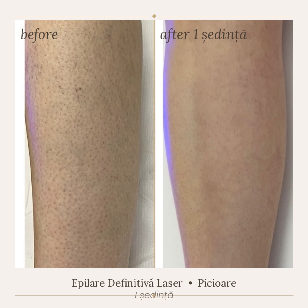Rezultat epilare definitivă picioare SkinXpert